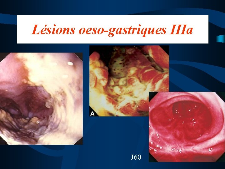 Lésions oeso-gastriques IIIa J 60 