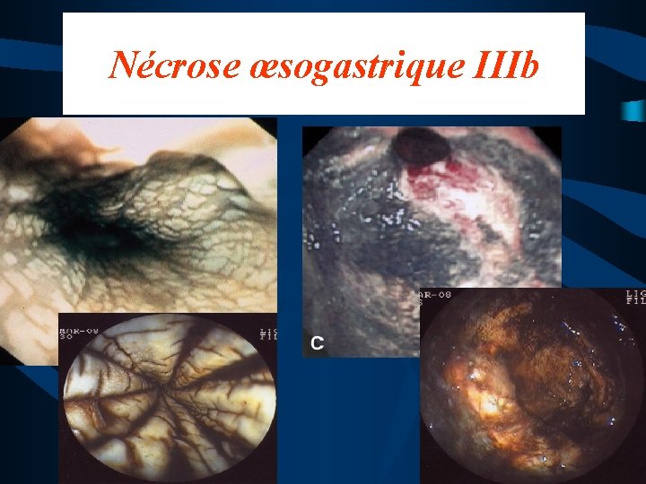 Nécrose œsogastrique IIIb 