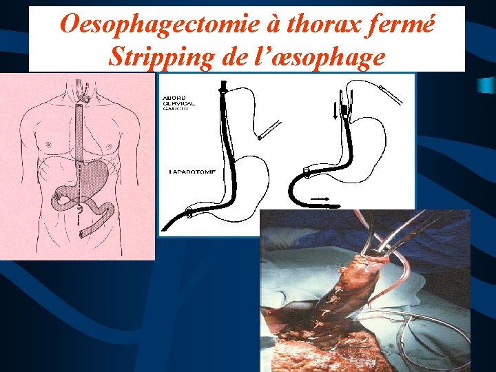 Oesophagectomie à thorax fermé Stripping de l’œsophage 