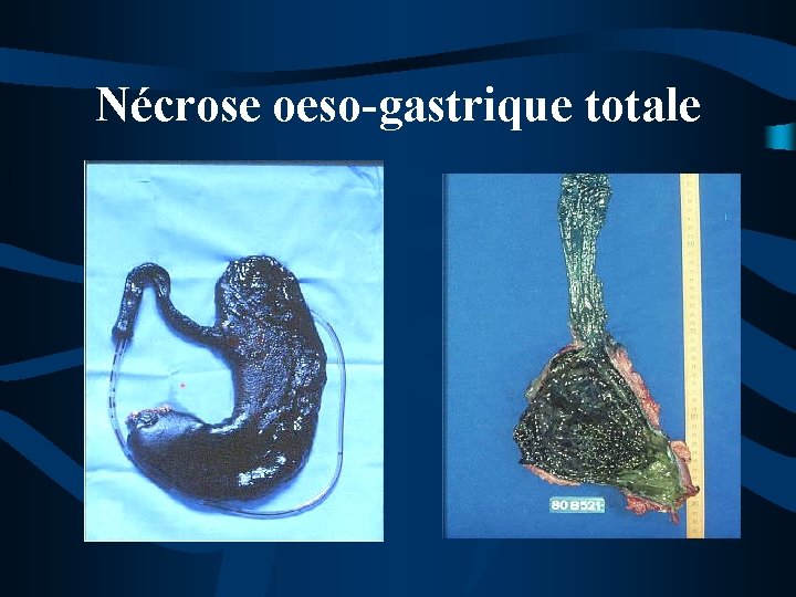 Nécrose oeso-gastrique totale 