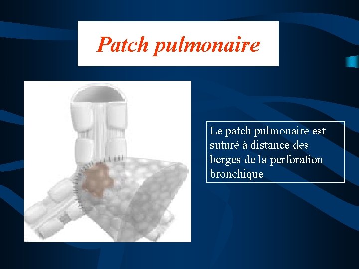 Patch pulmonaire Le patch pulmonaire est suturé à distance des berges de la perforation