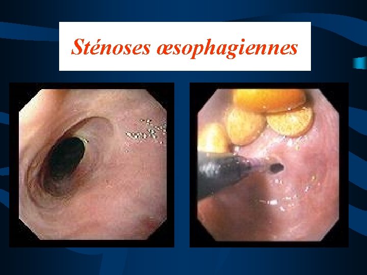 Sténoses œsophagiennes 