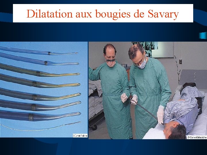 Dilatation aux bougies de Savary 