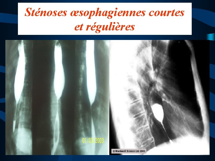 Sténoses œsophagiennes courtes et régulières 