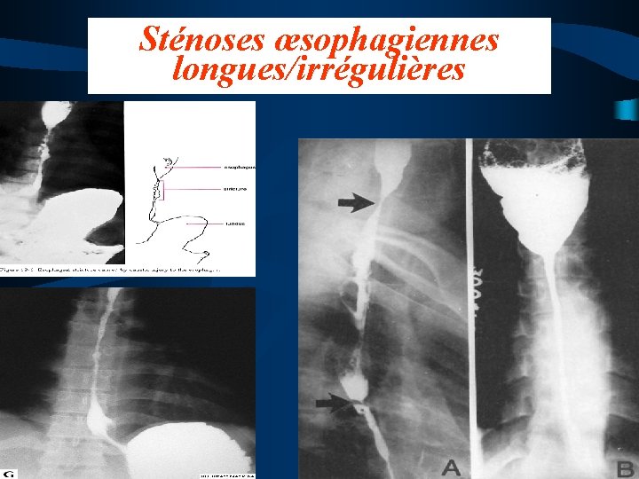 Sténoses œsophagiennes longues/irrégulières • 