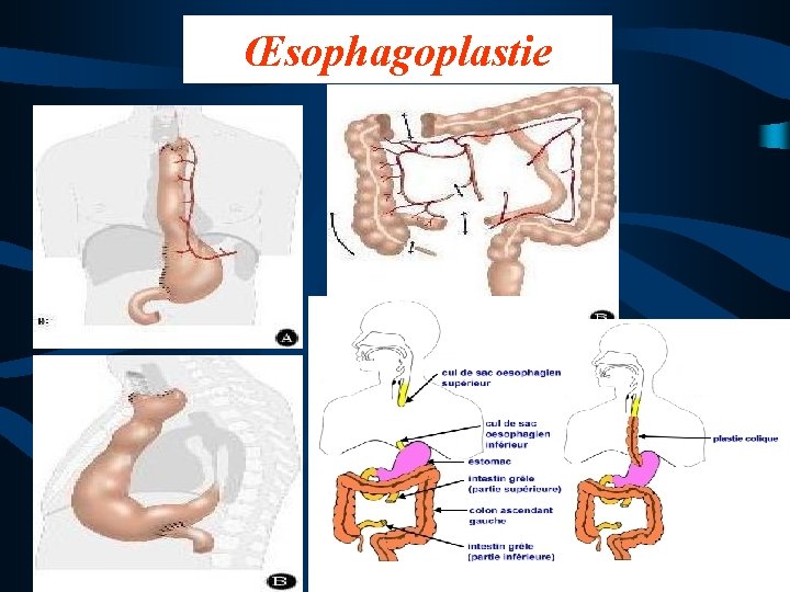 Œsophagoplastie 