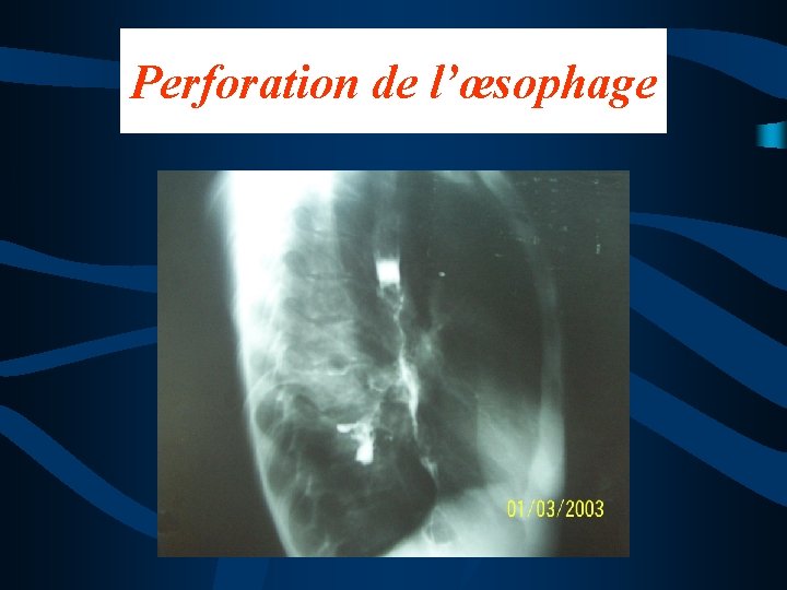 Perforation de l’œsophage 