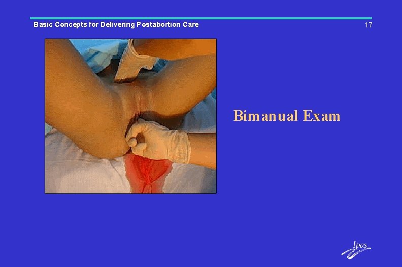 Basic Concepts for Delivering Postabortion Care 17 Bimanual Exam 