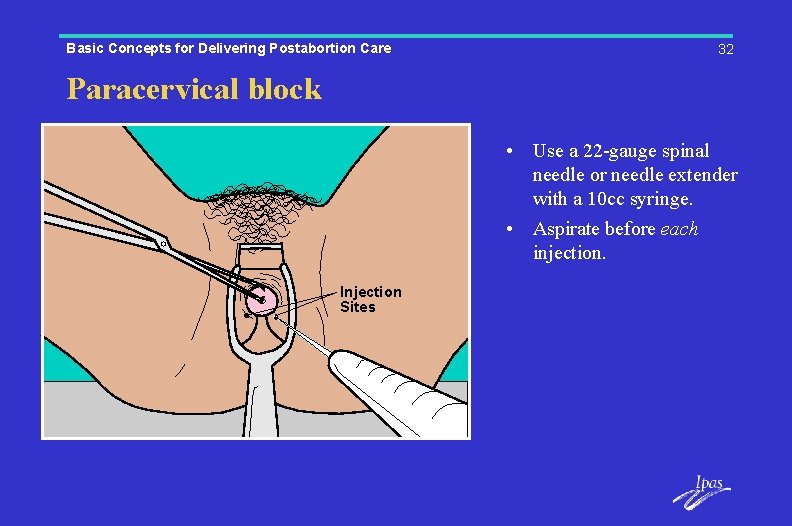 Basic Concepts for Delivering Postabortion Care 32 Paracervical block • Use a 22 -gauge