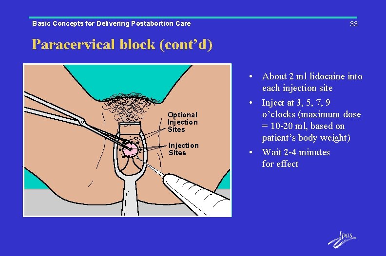 Basic Concepts for Delivering Postabortion Care 33 Paracervical block (cont’d) Optional Injection Sites •