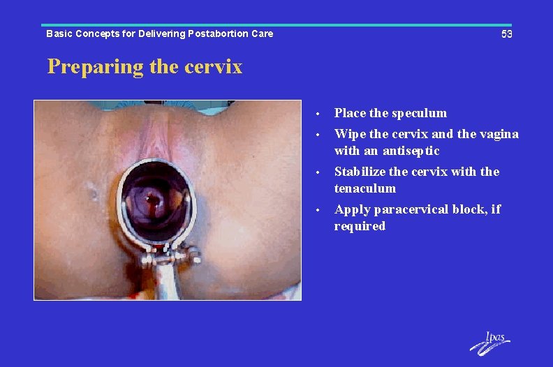 Basic Concepts for Delivering Postabortion Care 53 Preparing the cervix • • Place the
