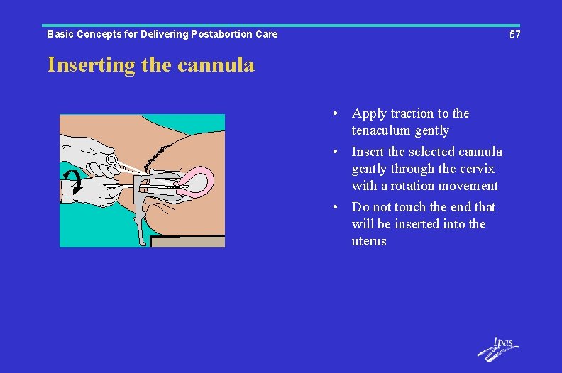 Basic Concepts for Delivering Postabortion Care 57 Inserting the cannula • Apply traction to