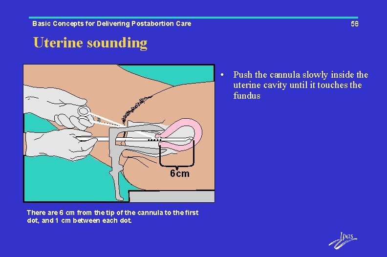 Basic Concepts for Delivering Postabortion Care 58 Uterine sounding • Push the cannula slowly