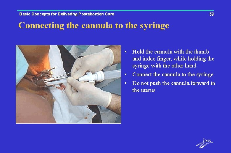 Basic Concepts for Delivering Postabortion Care 59 Connecting the cannula to the syringe •