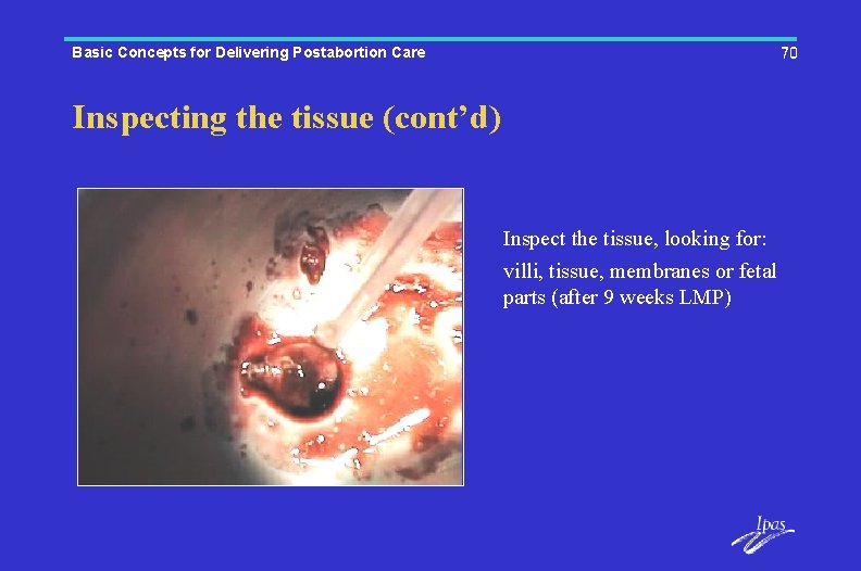 Basic Concepts for Delivering Postabortion Care 70 Inspecting the tissue (cont’d) Inspect the tissue,