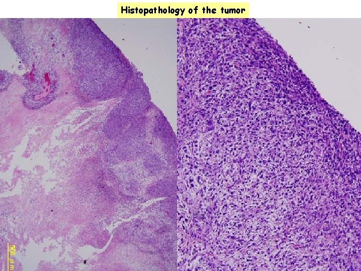 Histopathology of the tumor 