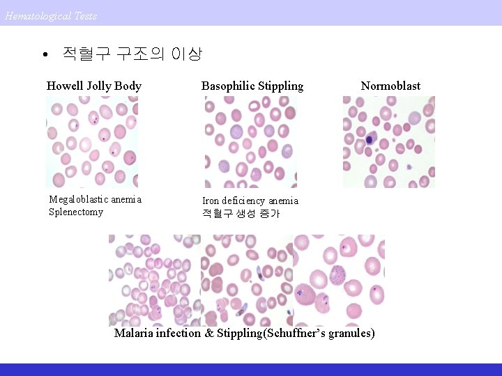 Hematological Tests • 적혈구 구조의 이상 Howell Jolly Body Basophilic Stippling Megaloblastic anemia Splenectomy