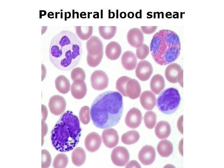 Peripheral blood smear 