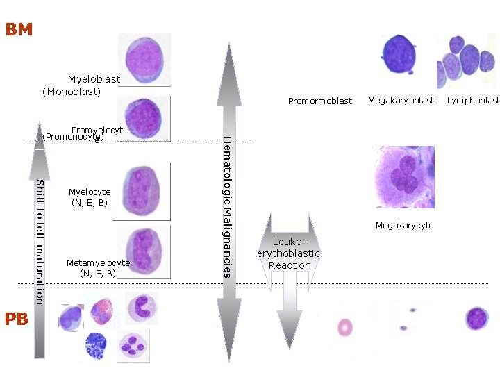 BM Myeloblast (Monoblast) Shift to left maturation PB Myelocyte (N, E, B) Metamyelocyte (N,
