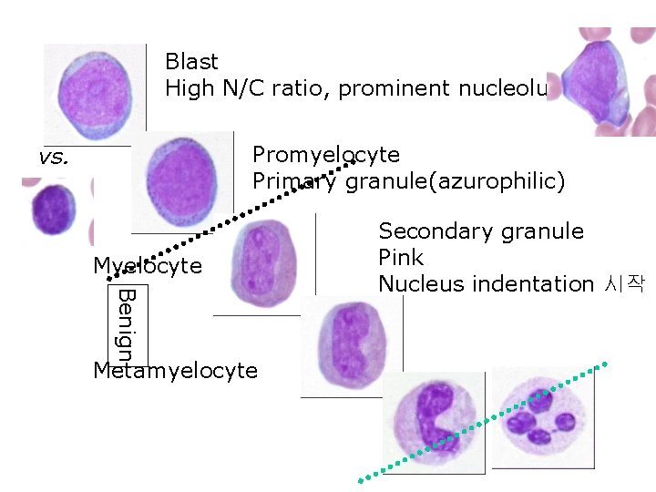 Blast High N/C ratio, prominent nucleolus Promyelocyte Primary granule(azurophilic) vs. Myelocyte Benign Metamyelocyte Secondary