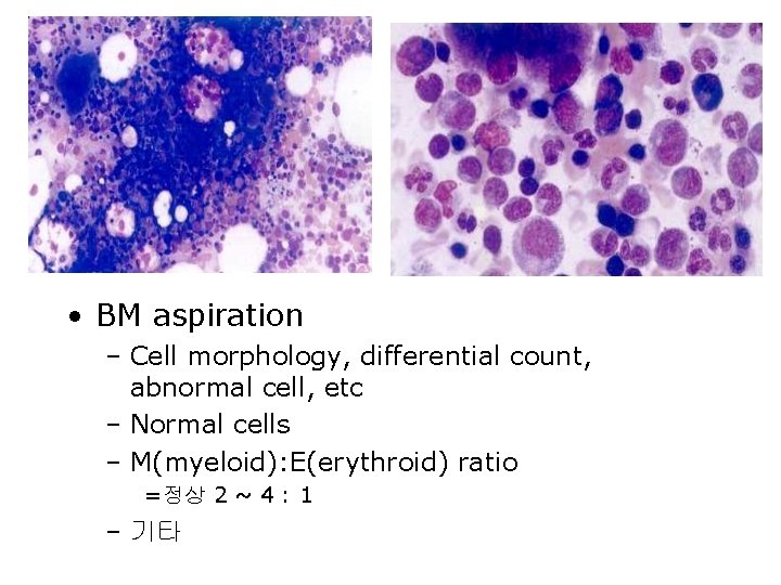  • BM aspiration – Cell morphology, differential count, abnormal cell, etc – Normal