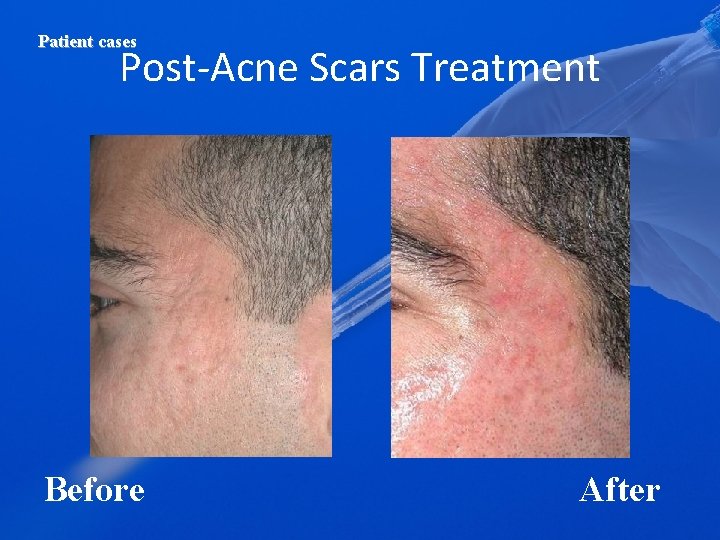 Patient cases Post-Acne Scars Treatment Before After 