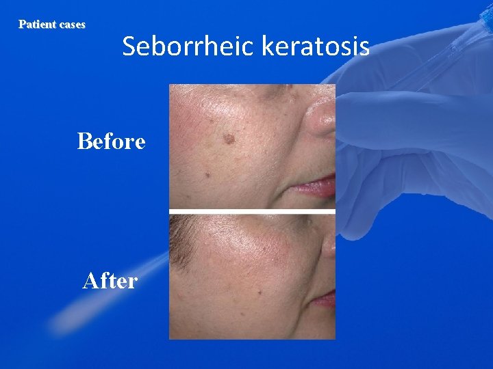 Patient cases Seborrheic keratosis Before After 