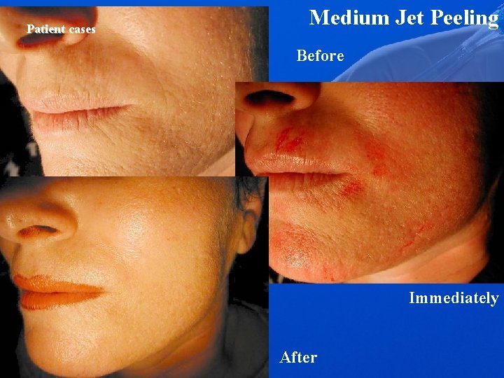 Patient cases Medium Jet Peeling Before Immediately After 