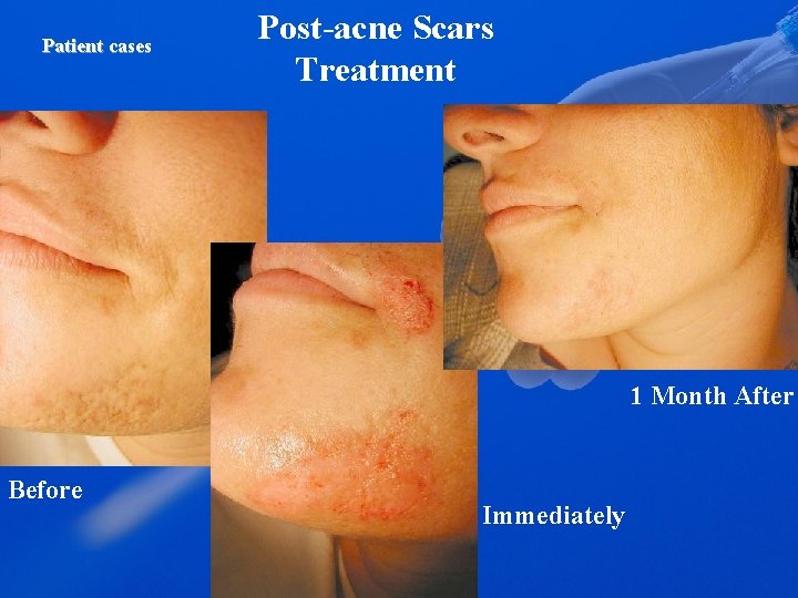 Patient cases Post-acne Scars Treatment 1 Month After Before Immediately 