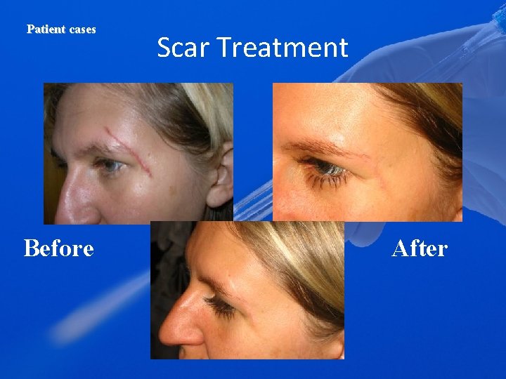 Patient cases Before Scar Treatment After 