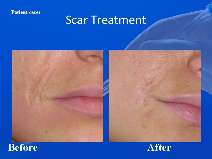 Patient cases Before Scar Treatment After 