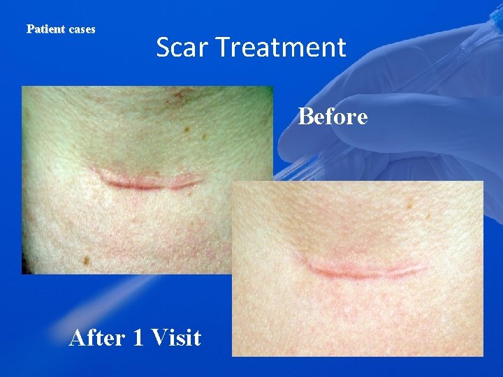 Patient cases Scar Treatment Before After 1 Visit 