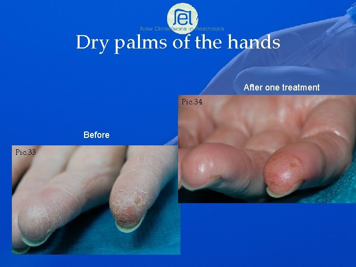 Dry palms of the hands After one treatment Pic. 34 Before Pic. 33 