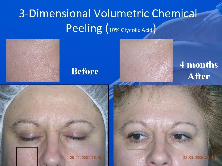 3 -Dimensional Volumetric Chemical Peeling (10% Glycolic Acid) Before 4 months After 