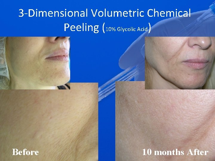 3 -Dimensional Volumetric Chemical Peeling (10% Glycolic Acid) Before 10 months After 