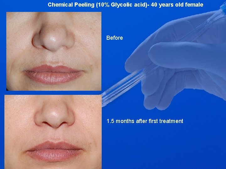 Chemical Peeling (10% Glycolic acid)- 40 years old female Before 1. 5 months after