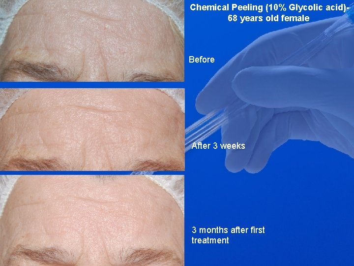 Chemical Peeling (10% Glycolic acid)68 years old female Before After 3 weeks 3 months