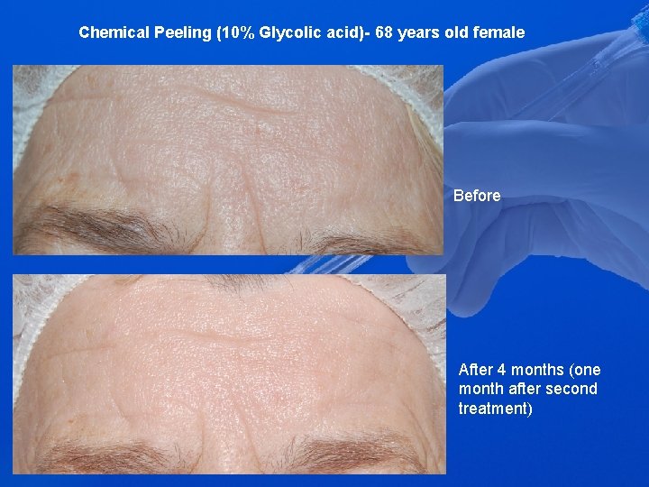 Chemical Peeling (10% Glycolic acid)- 68 years old female Before After 4 months (one