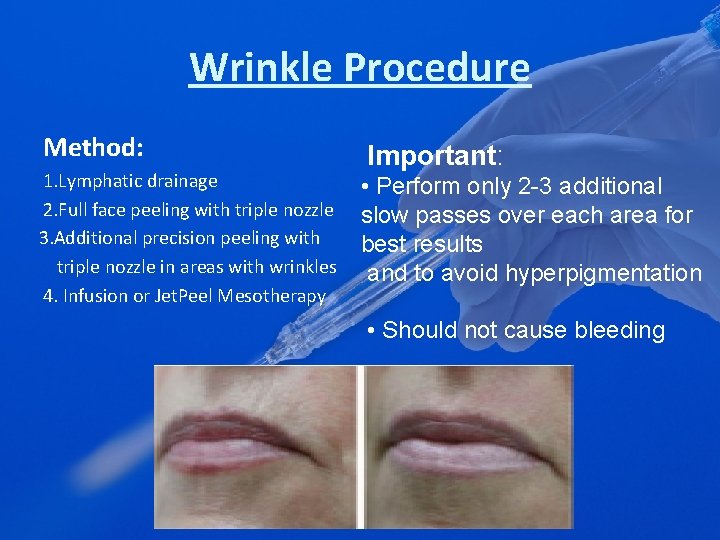 Wrinkle Procedure Method: 1. Lymphatic drainage 2. Full face peeling with triple nozzle 3.