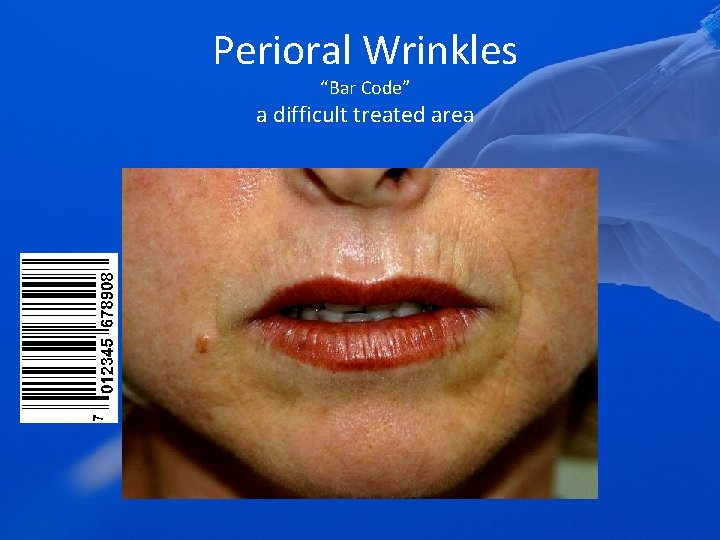 Perioral Wrinkles “Bar Code” a difficult treated area 