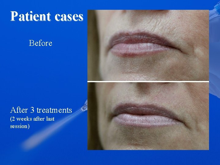Patient cases Before After 3 treatments (2 weeks after last session) 
