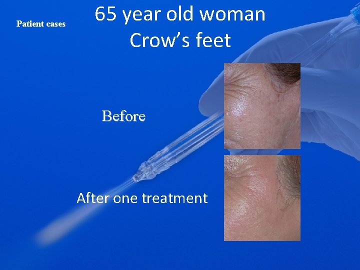 Patient cases 65 year old woman Crow’s feet Before After one treatment 