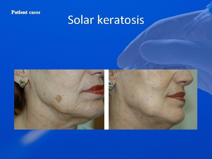 Patient cases Solar keratosis 