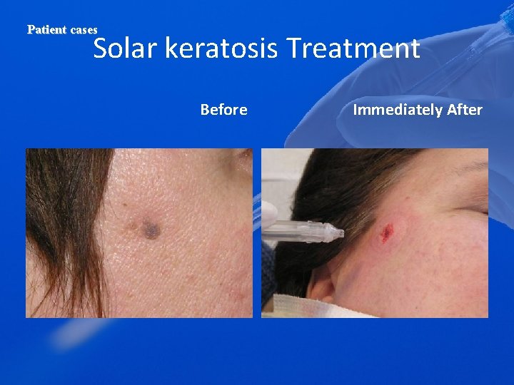 Patient cases Solar keratosis Treatment Before Immediately After 