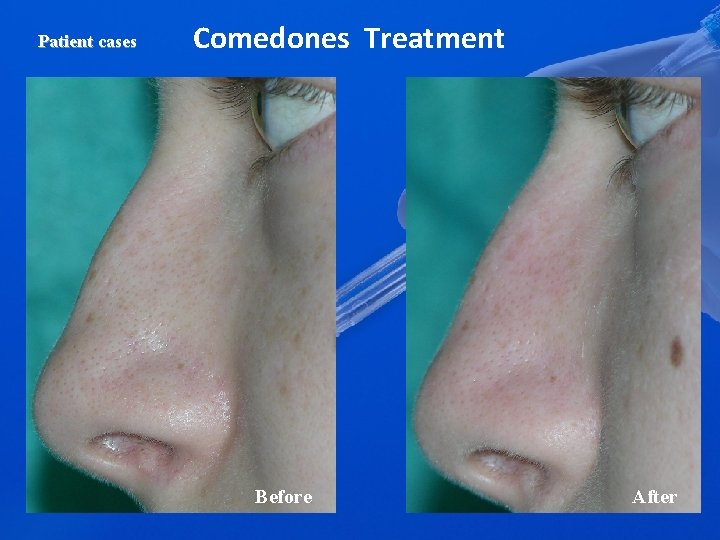 Patient cases Comedones Treatment Before After 