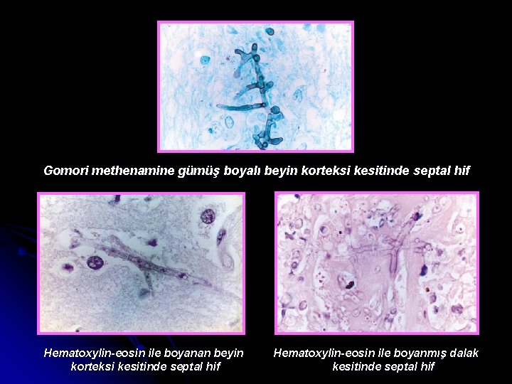 Gomori methenamine gümüş boyalı beyin korteksi kesitinde septal hif Hematoxylin-eosin ile boyanan beyin korteksi