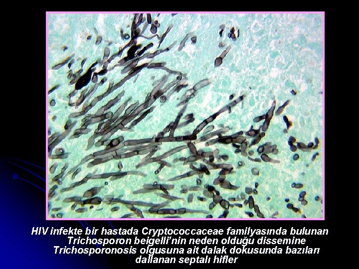 HIV infekte bir hastada Cryptococcaceae familyasında bulunan Trichosporon beigelli’nin neden olduğu dissemine Trichosporonosis olgusuna