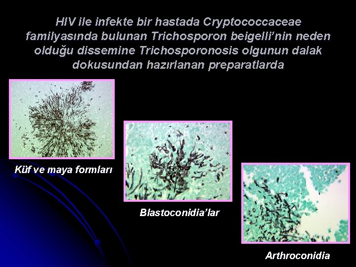 HIV ile infekte bir hastada Cryptococcaceae familyasında bulunan Trichosporon beigelli’nin neden olduğu dissemine Trichosporonosis