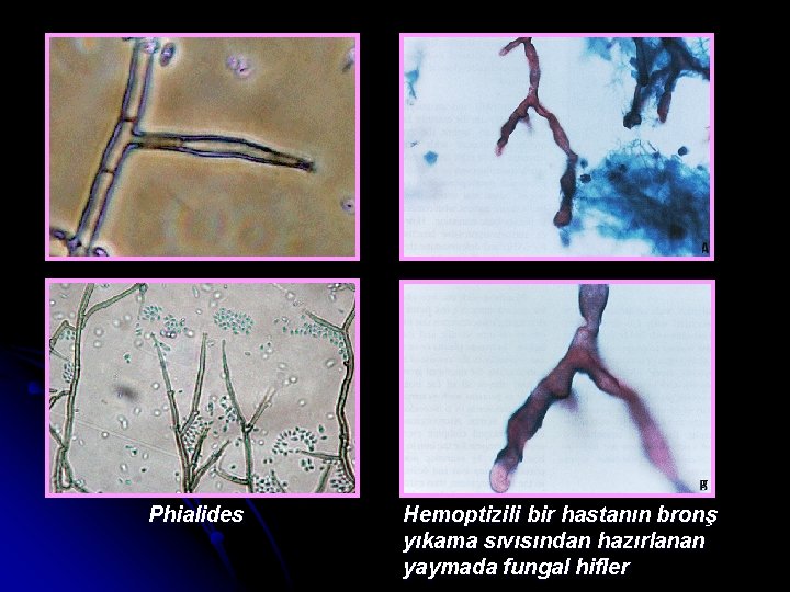 Phialides Hemoptizili bir hastanın bronş yıkama sıvısından hazırlanan yaymada fungal hifler 