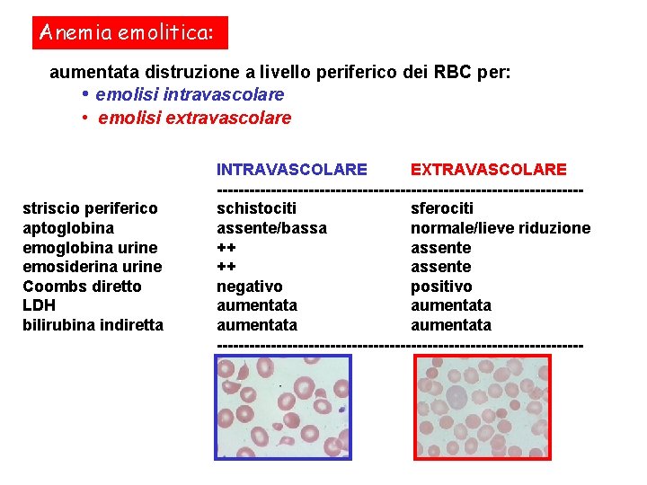 Anemia emolitica: aumentata distruzione a livello periferico dei RBC per: • emolisi intravascolare •